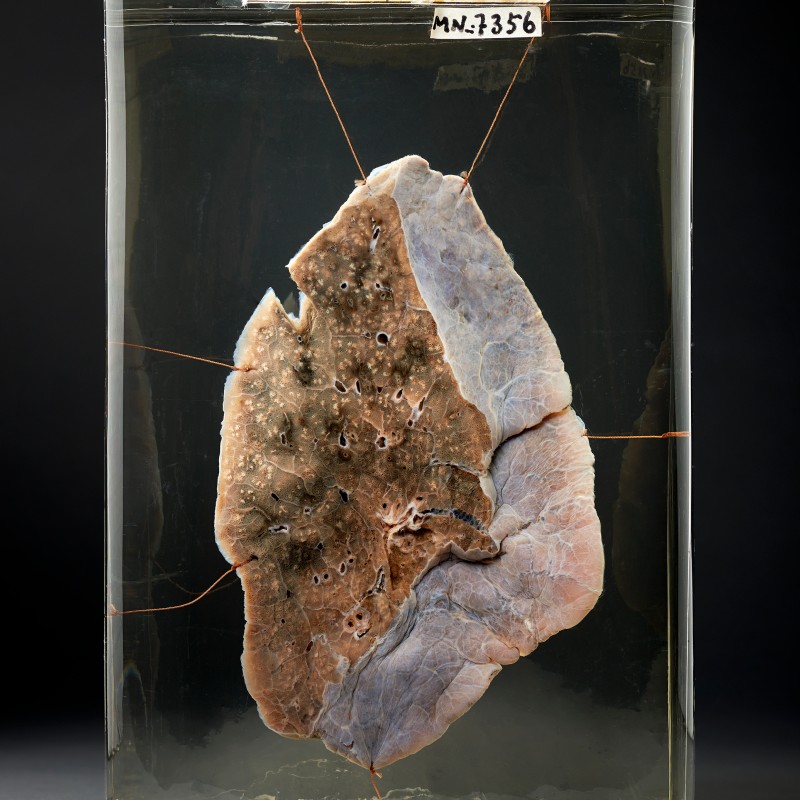 Preserved human lung section in glass container, showing pale and dark tissue areas. (AI-generated alt-text, generated
                                 with GPT-4.1-mini)
