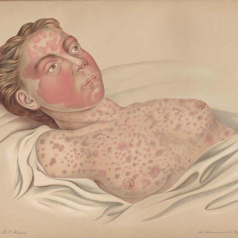 A person infected with colera (Atlas der Hautkrankheiten von Ferdinand
                                 von Hebra, 1856) | © Narrenturm 