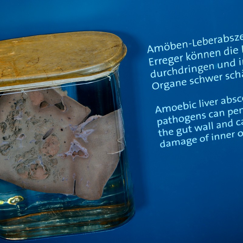 Large glass jar containing gray-brown liver tissue in liquid, set against a blue background. Visible tissue changes
                                 and spots. (AI-generated alt-text, generated with GPT-4.1-mini)