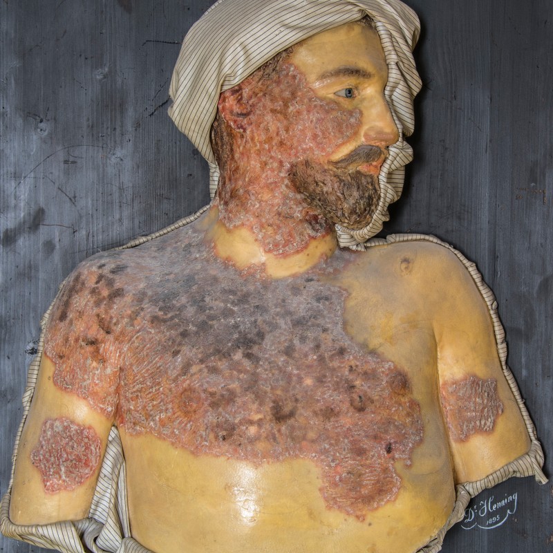 Wachsmodell
                                 eines männlichen Brustkorbs mit Bart, Tuch auf dem Kopf und ausgeprägten dunklen Hautveränderungen am Oberkörper. (KI-generierter
                                 Alt-Text, erstellt mit GPT-4.1-mini)