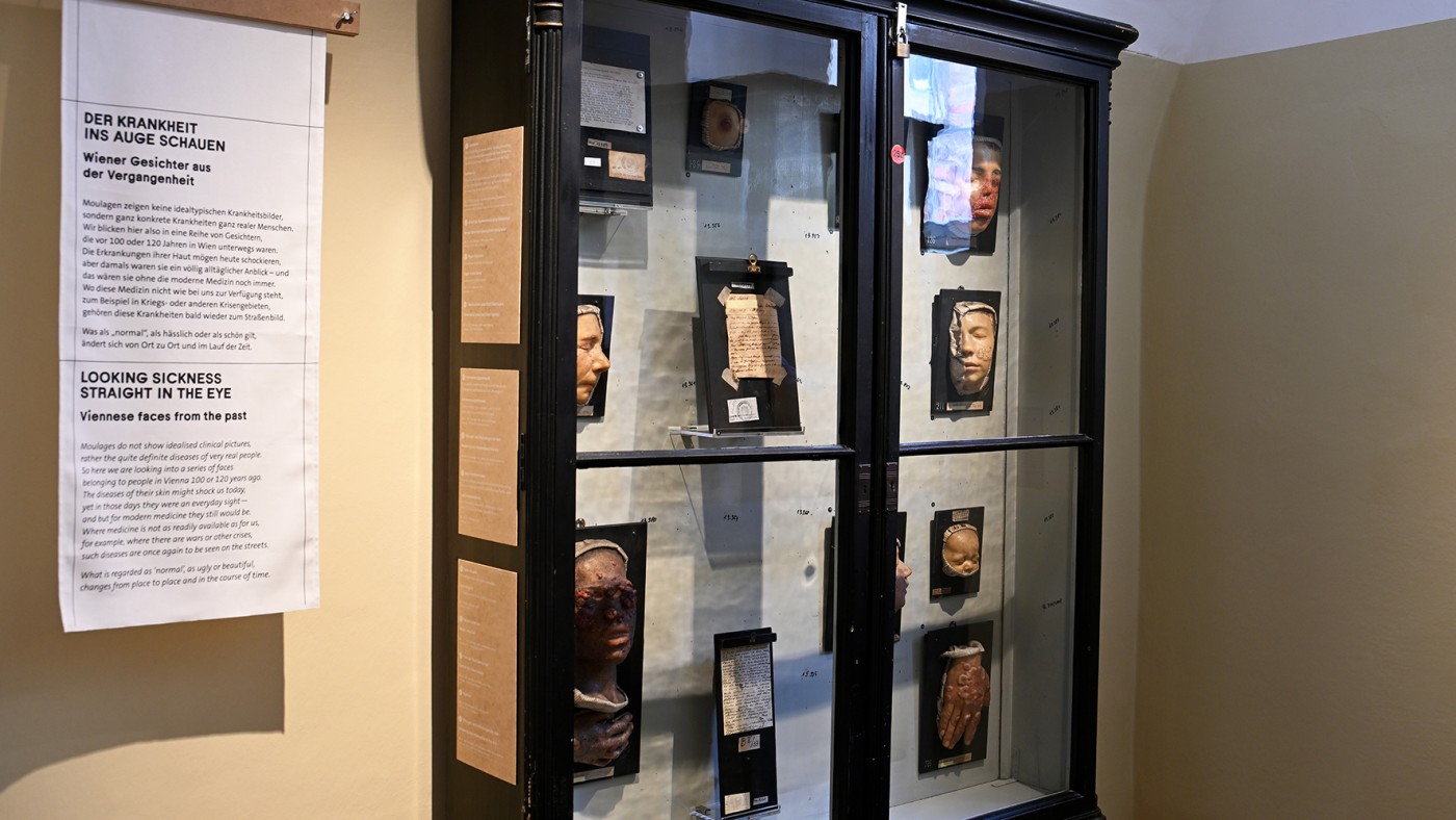 Kunst der Moulage
- verewigte Krankheitsbilder _ Ausstellungsansicht 2